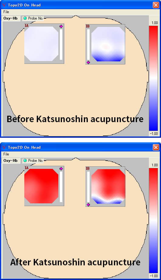  Katsunoshin acupuncture